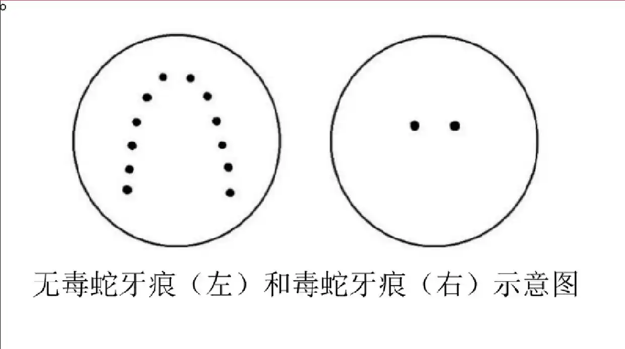 蛇咬牙印图_毒蛇咬伤的牙印是什么样的_
